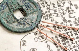 Acupuncture Near Me Basildon