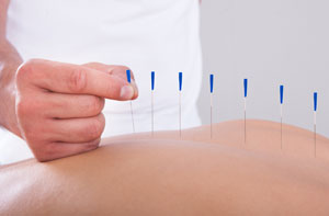 Acupuncture for Pain Relief Blyth Acupuncture for Pain Relief Blyth