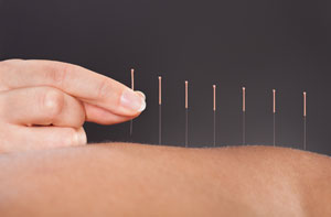 Acupuncture Basingstoke
