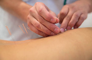 Acupuncture Exeter Devon