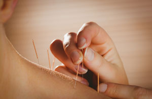 Does Acupuncture Work? Does Acupuncture Work?